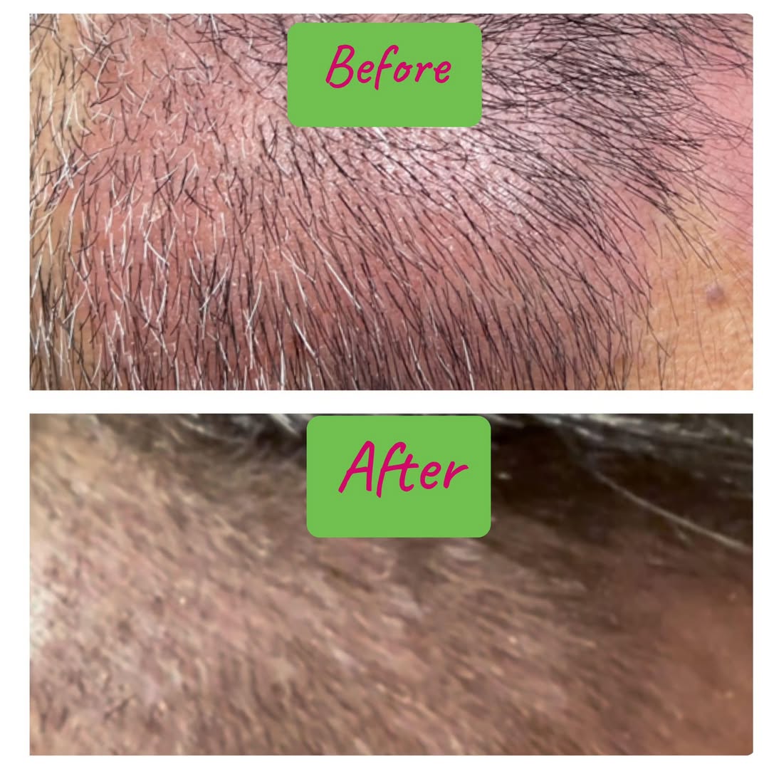 Psoriasis